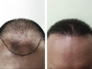 Μεταμόσχευση μαλλιών πριν και μετα