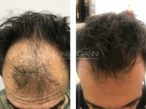 Μεταμόσχευση μαλλιών πριν και μετα